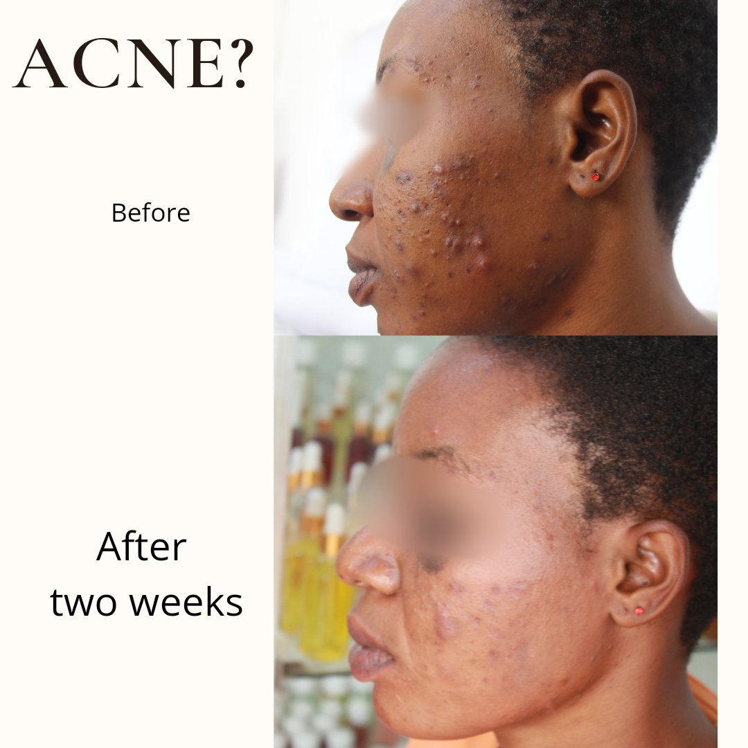 Acne face. before & after